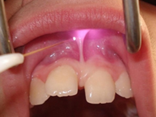 Laser-Assisted Periodontal Therapy: What the Evidence Actually Supports