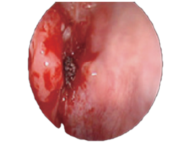 Turbinate Reduction Without the Crusting: Delivery Mode and Fiber Choice