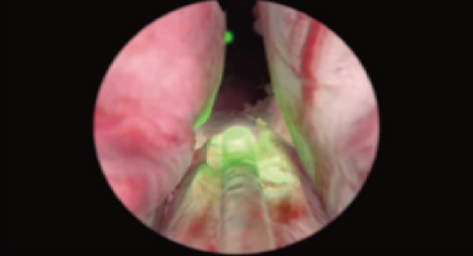 Dusting or Fragmentation: The Fiber Diameter Decision in Flexible Ureteroscopy